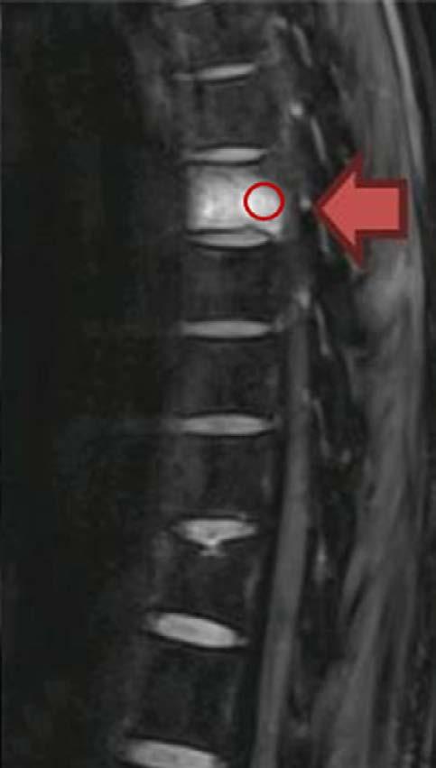 In addition, their fracture lesions were stable during the imaging follow-up of 6 months or longer.