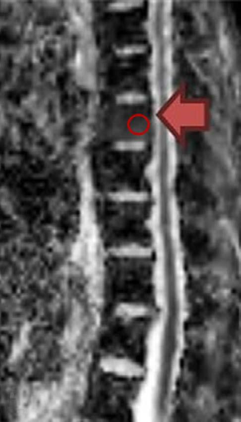 Image Analysis Four radiologists with various years of experience in spine MRI performed the qualitative and quantitative measurements at the fracture sites.