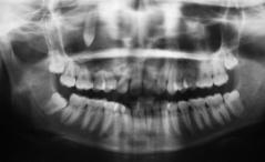 obliterating the buccal vestibule. The swelling was oval in shape measuring 2 1.5 cm, the overlying mucosa was normal, and the right maxillary canine was missing.