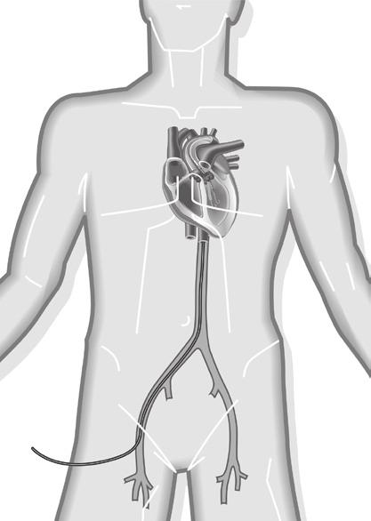 Impella As the efficacy of IABP support seems limited, several other minimally invasive circulatory support devices have been developed.