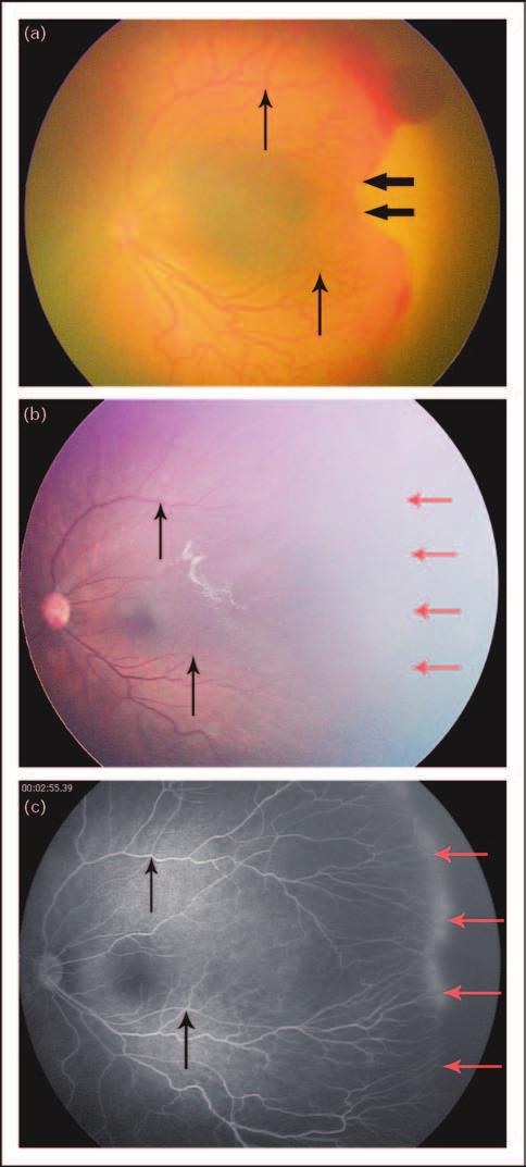 Antivascular endothelial growth factor for retinopathy of prematurity Mintz-Hittner and Best 185 continued vascularization of the peripheral retina is demonstrated by fluorescein angiography (Fig. 1).