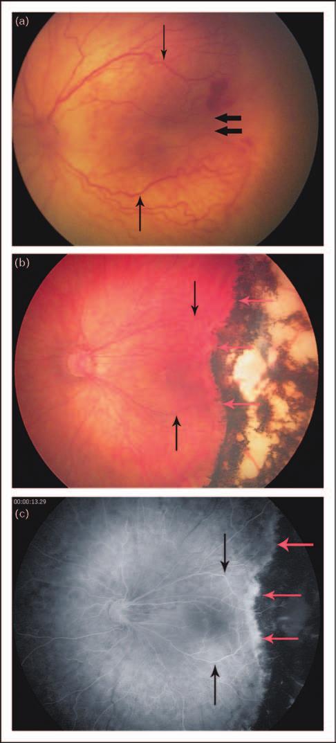 186 Neonatology and perinatology Figure 2 Photographs of LASER treatment for retinopathy of prematurity were harvested 20 weeks following bilateral intravitreal Avastin injections demonstrated no