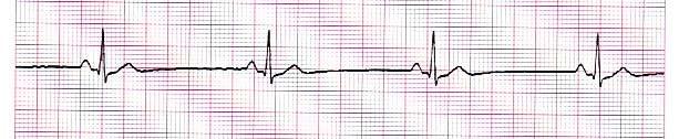 Algorithm Practice: Bradycardia The patient s ECG (6 second strip): You are called to the residence of a 65 year-old male complaining of being unusually tired.
