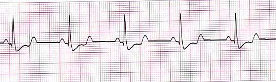 His blood pressure is 142/80 while supine, HR of 52, and RR of 14. Patient appears pale. He is alert and answers questions appropriately. Stable or Unstable? What is your rhythm interpretation?