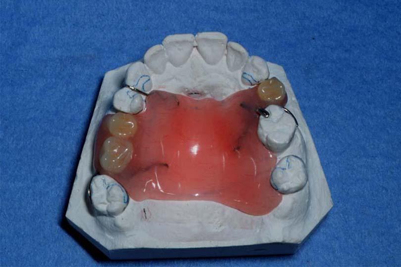 ACRYLIC REMOVABLE PARTIAL DENTURE(RPD) is a dental prosthesis which artificially supplies teeth and associated structure in a partially edentulous arch, made from acrylic resin and can be inserted