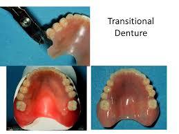 2. Interim partial denture 3. Treatment partial denture. 1.