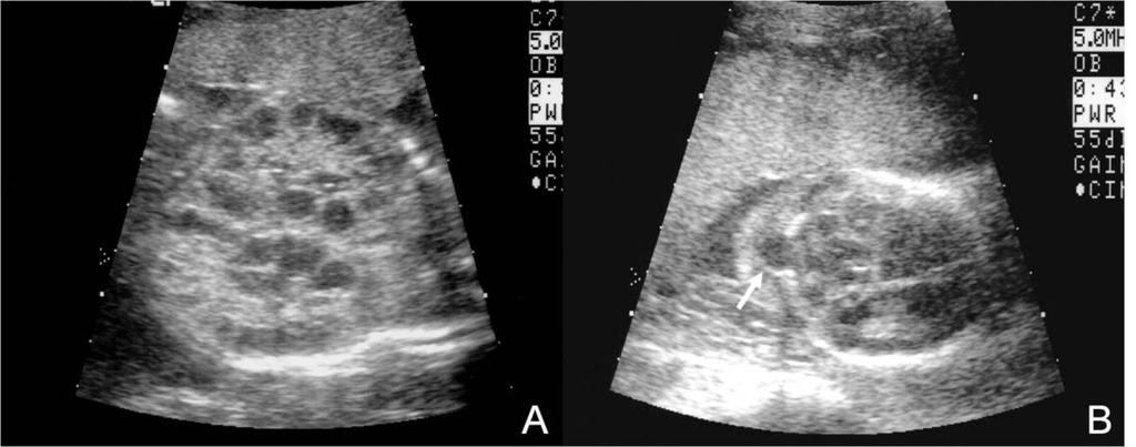 Fig.: 11. US findings of Meckel-Gruber Syndrome A. Coronal image of a fetal abdomen shows multiple cysts in both kidneys, suggesting multicystic dysplasia.