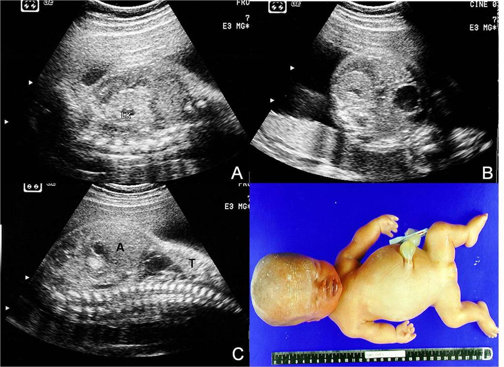 Fig.: 12. US and autopsy findings of Jeune Syndrome A & B. Longitudinal and axial images of fetal kidneys show mildly increased size and echogenicity of both kidneys. C.