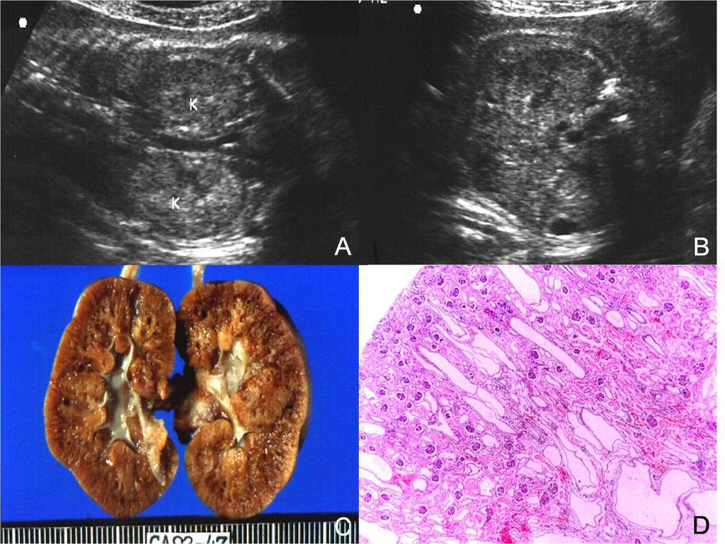 Fig.: 13. US & autopsy findings of medullary cystic disease A & B Coronal image shows mildly increased parenchymal echogenecity of enlarged both kidneys.