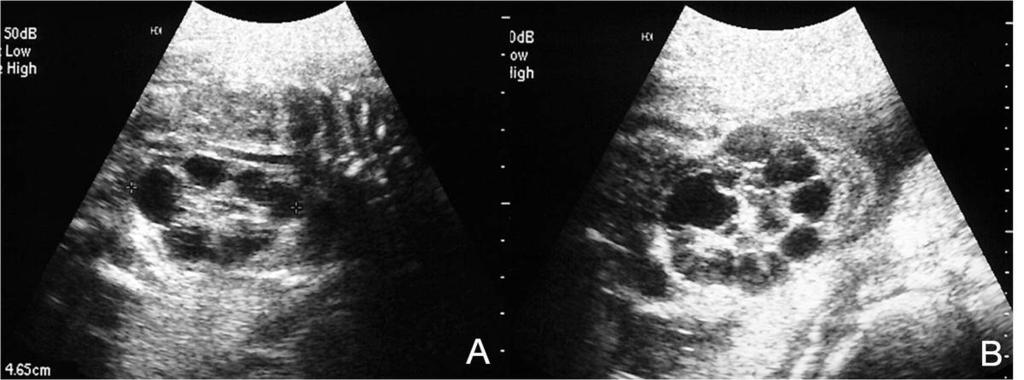Fig.: 1. US findings of unilateral MCDK A & B. There are multiple variable size cysts in the left kidney.