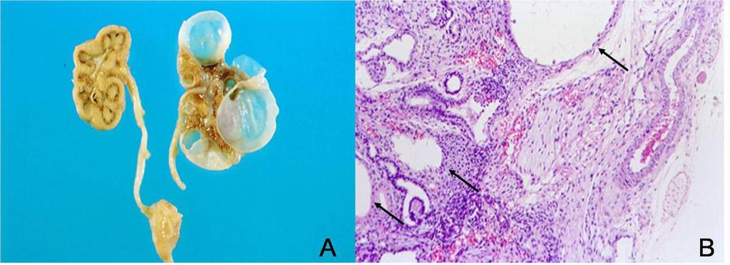 Pathologic findings of MCDK A. On the cut surface photography, there are well defined multiple cysts in the left kidney.