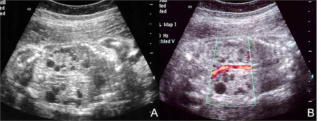 Fig.: 3. US findings of bilateral MCDK A. There are multiple variable size cysts in both kidneys without normal parenchymal echo.