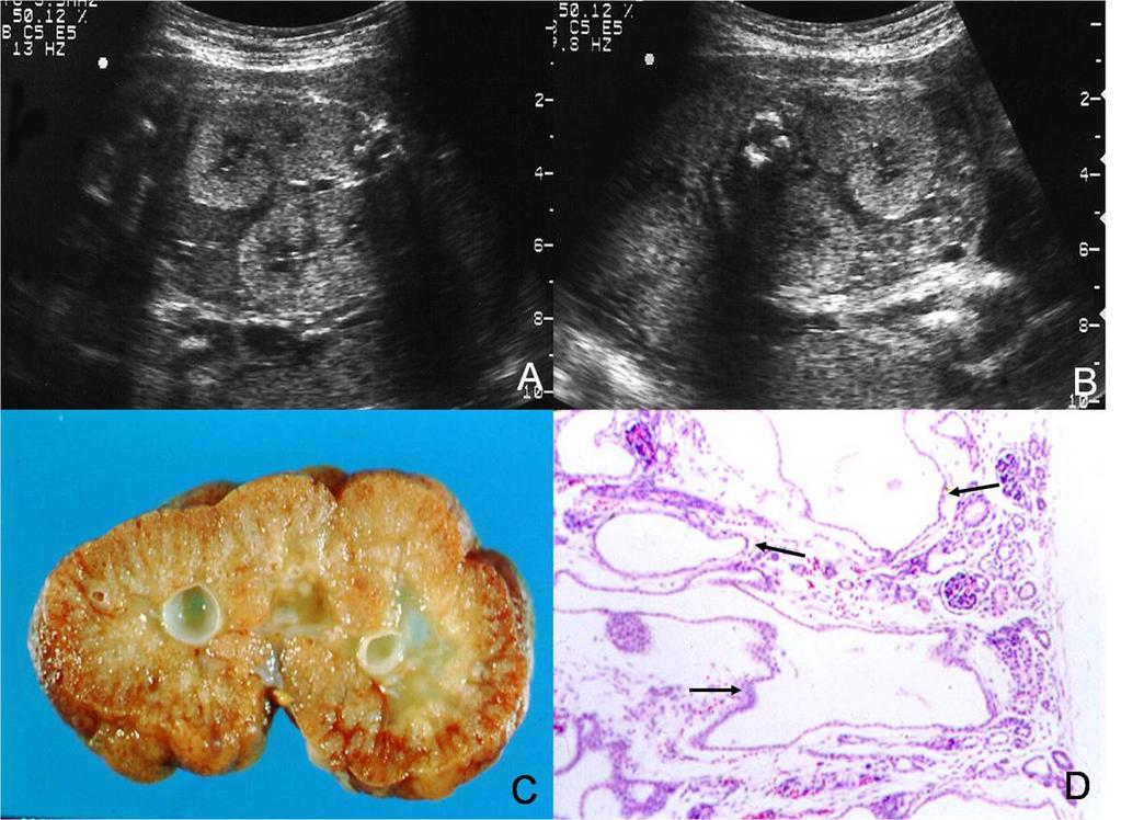 Fig.: 6. US and autopsy findings of a fetus with ARPCK References: S. Moon; Radiology, Seoul National University Hospital, Seoul, KOREA, A & B.