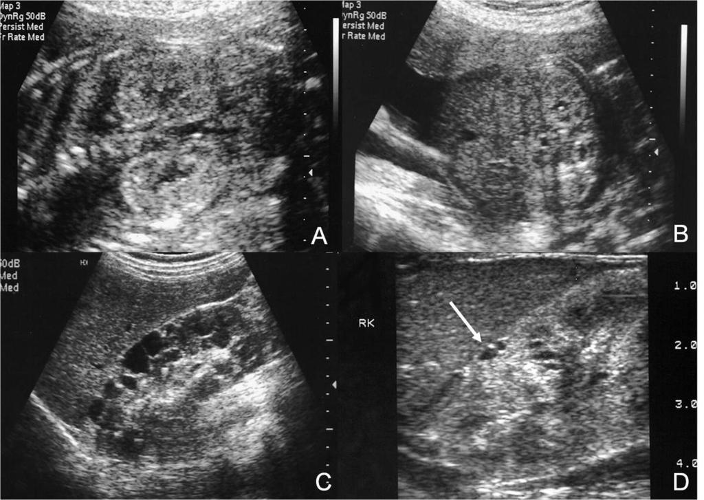 to multiple interfaced of numerous tiny cysts which are usually smaller than the limit of sonographic resolution. Fig.: 7. US findings of ADPCK A & B.
