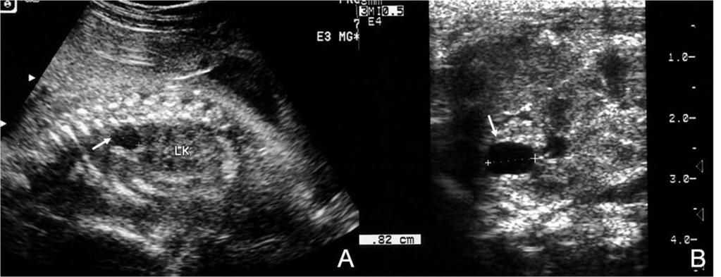 B. Photomicrography shows multiple subcapsular cysts (arrows). *Simple Renal Cyst Fig.: 10. US findings of a fetus with simple renal cyst A.