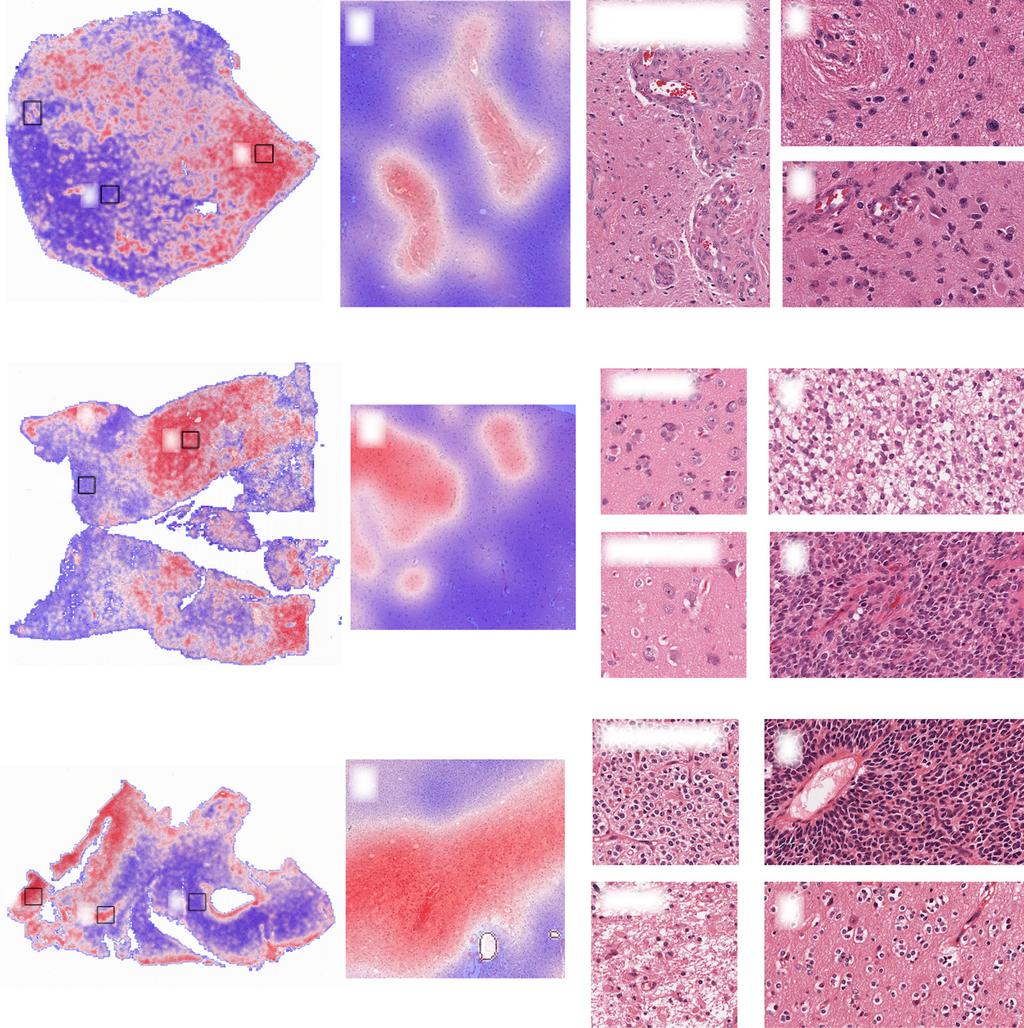 TCGA-DB-57 (IDH-mut astrocytoma) Early microvascular proliferation 50μm.5mm 50μm 00μm TCGA-S9-A7J0 (IDH-mut astrocytoma) Infiltration 50μm Normal cortex 00μm.