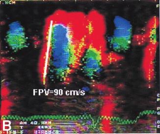 JACC Vol. 34, No. 2, 1999 August 1999:515 23 Gonzalez-Vilchez et al. Color M-mode Doppler and Capillary Wedge Pressure 517 Figure 1.