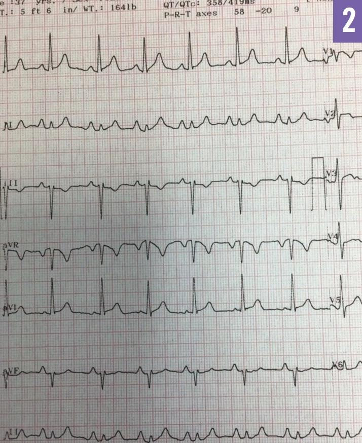 Figure 2: ECG recorded 8 days after radiofrequency catheter