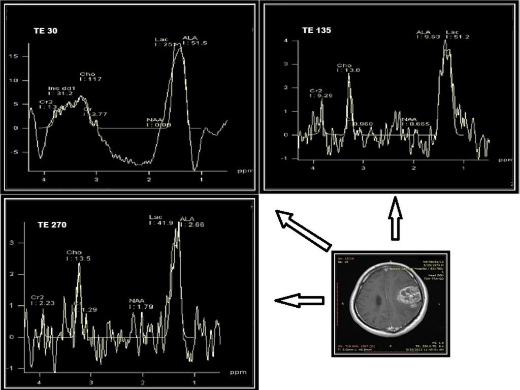 Fig. 3: Magnetic Resonance Spectroscopy Of Intracranial
