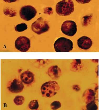 Apoptotic cells increased in a dose-dependent manner in the two kinds of leukemia. Cells were treated with different concentrations of 15-deoxy-delta(12,14)-prostaglandin J2 (15d-PGJ2) for 72 h.