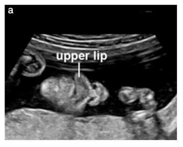 ISUOG Guideline Minimum evaluation of the fetal face should include an attempt to visualise the upper lip for possible cleft anomaly If technically feasible, other facial features that can be
