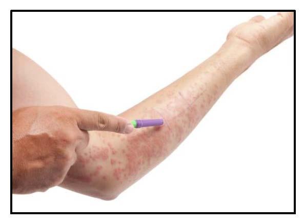 Skin Sensitization Allergic Contact Dermatitis