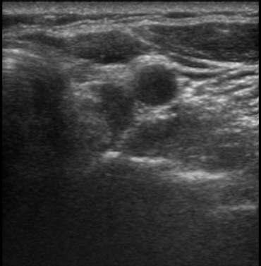 Neck Ultrasound 0.75 cm Fig.