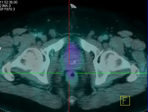 rectum before neoadjuvant treatment. B. 18 F-FDG PET/TC without pathological uptake after neoadjuvant treatment. Fig. 2.