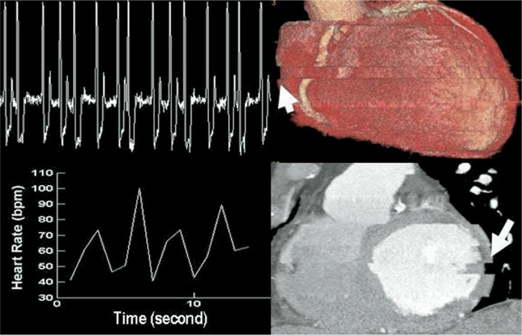 Zhang et al. Page 8 Figure 1. An example of an erratic heart rate and the resultant CT images in a patient with atrial fibrillation or other arrhythmia.