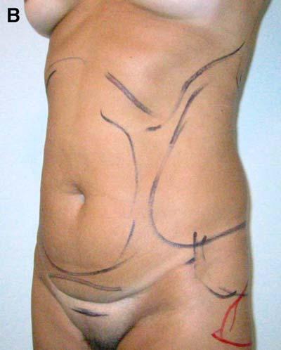 The abdominoplasty incision is closed subcutaneously with mononylon 3-0 or 4-0 and with a subcuticular suture of 4-0 monocryl. Dressing with micropore is applied over the abdominoplasty incision.