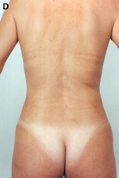 benefit from lipoplasty alone, without need for skin
