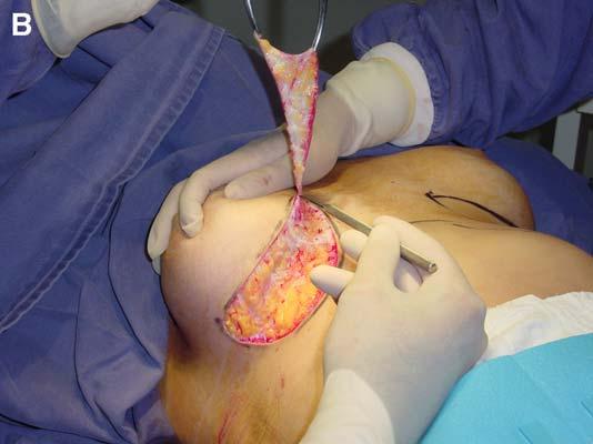 (C) The epigastrium was dissected bluntly with the help of a cannula. (D) The wound was closed in layers.