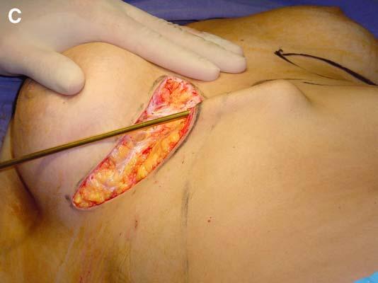 the dissected flap is also sutured to the abdominal wall aponeurosis with a quilting suture to avoid seromas [11].