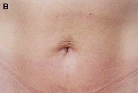 the longer abdominoplasty procedure and its extended recovery time, age, or disease that could compromise the result of the abdominoplasty (Fig. 9).