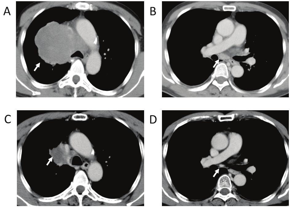 MIYOSHI et al: NEUROENDOCRINE CARCINOMA OF THE LUNG EXPRESSING ANAPLASTIC LYMPHOMA KINASE 189 Figure 1. Computed tomography scan prior to and following chemotherapy.