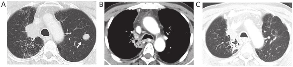 190 Figure 3. Computed tomography (CT) scan preformed 14 months after the patient's first visit to the hospital for the first neuroendocrine carcinoma (NEC) and for follow up.
