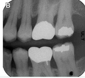 The radiograph should record the complete area of interest to allow assessment of alveolar crest height and the presence of furcation involvement or