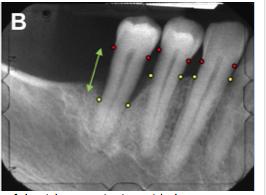 Materials and Methods The non- standardized periapical and bitewing dental radiographs studied were obtained from one general dental practice and two periodontal practices Radiographs were digitized