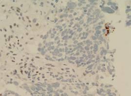 Immunohistochemistry p53 Carcinosarcoma A biphasic tumour in