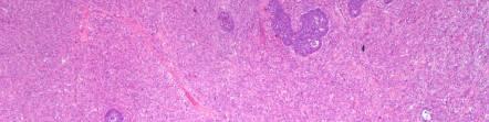 Chondrosarcoma Liposarcoma May be useful to comment on the