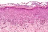 Familial Melanoma Familial Melanoma CDKN2a Familial atypical multiple mole melanoma (FAMM)/Dysplastic nevus syndrome