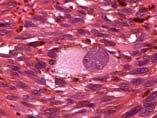 Cell Melanoma Melanoma
