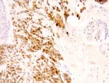 High Sensitivity for melanocytic tumours Expressed in Naevi and Melanoma Low specificity, also
