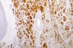 focal in benign and malignant blue naevi S100 Second line melanocytic marker: Good sensitivity