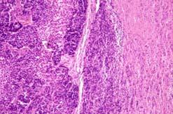 Expression in deep component seen in DPN/blue naevi, melanoma