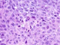 invasive tumours also seen in Spitzoid neoplasms MIB1 CyclinD1 P16 Melanoma