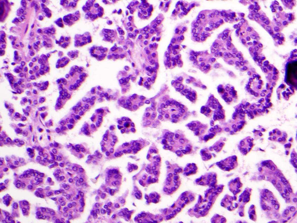 Papillary RCC The second most common type RCC Cytogenetic changes: +7, +17,