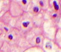 Chromophobe RCC Three Types of Cells Type 1: Eosinophilic cell with no perinuclear halo Type 2: