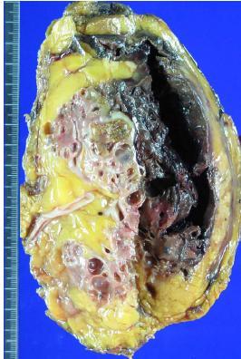 Acquired cystic disease associated RCC Most common subtype of RCC in endstage kidneys, especially with acquired cystic disease Incidence of cystic disease (>90% at 10 years or more) RCC: 3-7% in