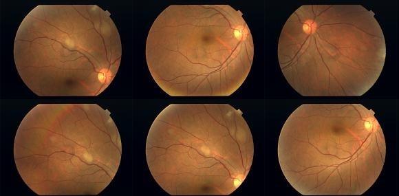 On ocular examination, the visual acuity was 6/6 OU with N5 near vision. The anterior segment examination was unremarkable with intraocular pressure (IOP) of 16mmHg bilaterally.